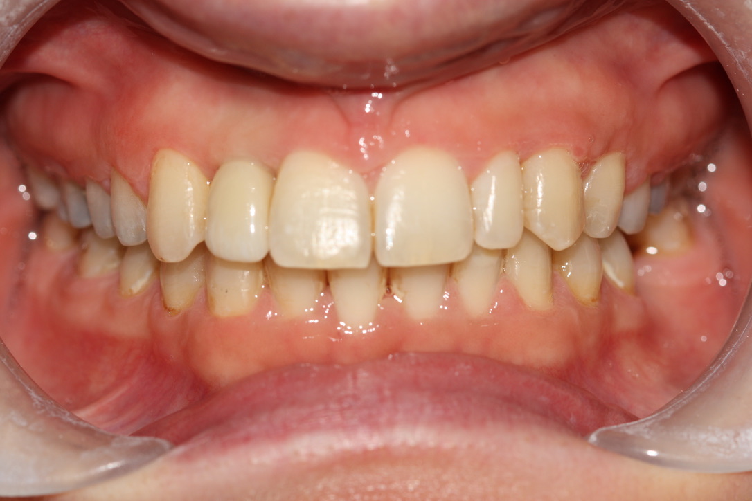 Dental Implants Leek